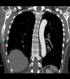 Aortic valve endocarditis (Radiopaedia 87209-103485 D 22).jpg