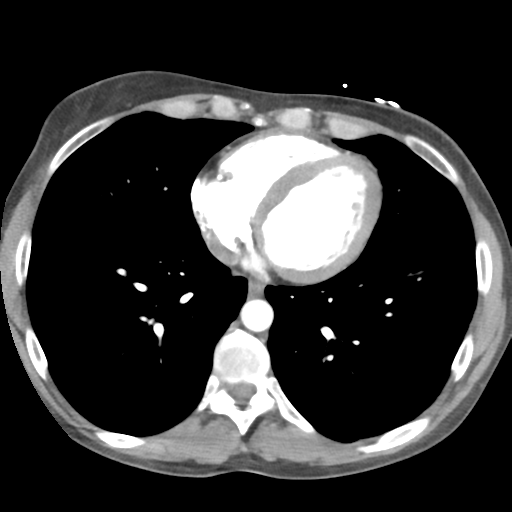 File:Aortic valve non-coronary cusp thrombus (Radiopaedia 55661-62189 B 34).png