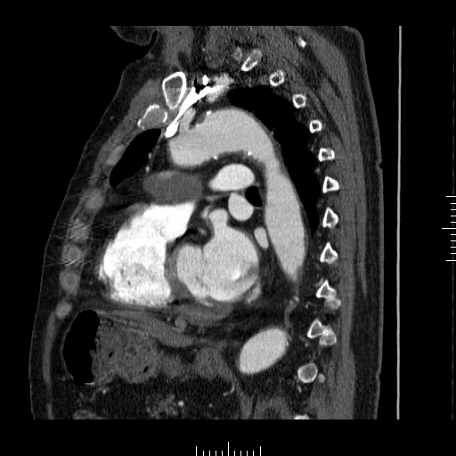 File:Aorto-coronary bypass graft aneurysms (Radiopaedia 40562-43157 C 24).png