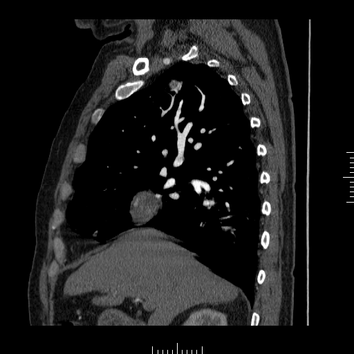 File:Aorto-coronary bypass graft aneurysms (Radiopaedia 40562-43157 C 6).png