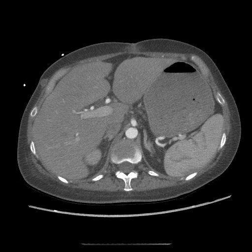 Aorto-duodenal fistula (Radiopaedia 25668-25850 A 14).jpg