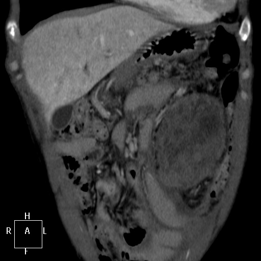 Aorto-left renal vein fistula (Radiopaedia 45534-49628 B 2).jpg