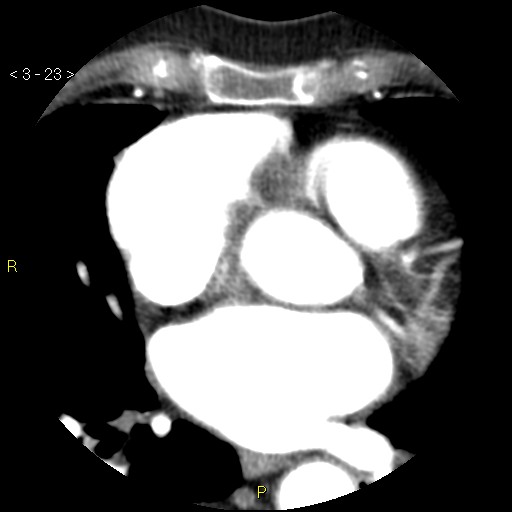 Aortoiliac occlusive disease (Radiopaedia 16828-16548 A 23).jpg
