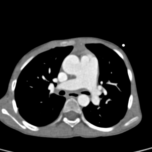 File:Aortopulmonary window, interrupted aortic arch and large PDA giving the descending aorta (Radiopaedia 35573-37074 B 39).jpg