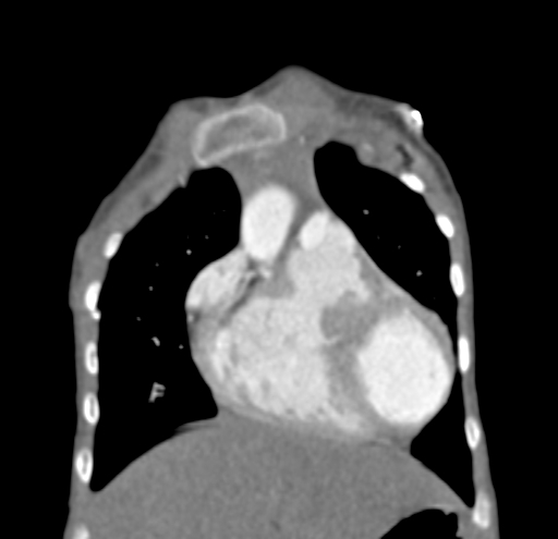 File:Aortopulmonary window, interrupted aortic arch and large PDA giving the descending aorta (Radiopaedia 35573-37074 D 12).jpg