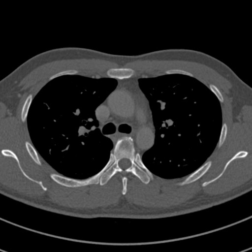 Apical lung mass mimic - neurogenic tumor (Radiopaedia 59918-67521 Axial bone window 30).jpg