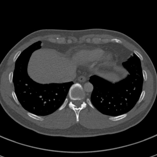 Apical lung mass mimic - neurogenic tumor (Radiopaedia 59918-67521 Axial bone window 65).jpg