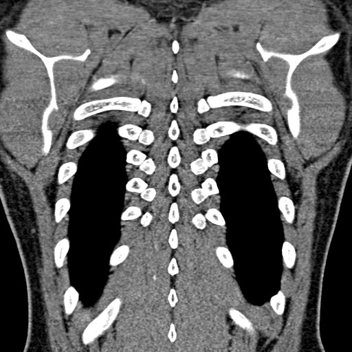 Apical lung mass mimic - neurogenic tumor (Radiopaedia 59918-67521 B 93).jpg