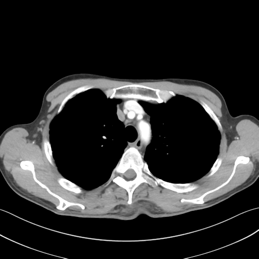 File:Apical pleural calcification (Radiopaedia 46141-50499 Axial C+ delayed 18).png
