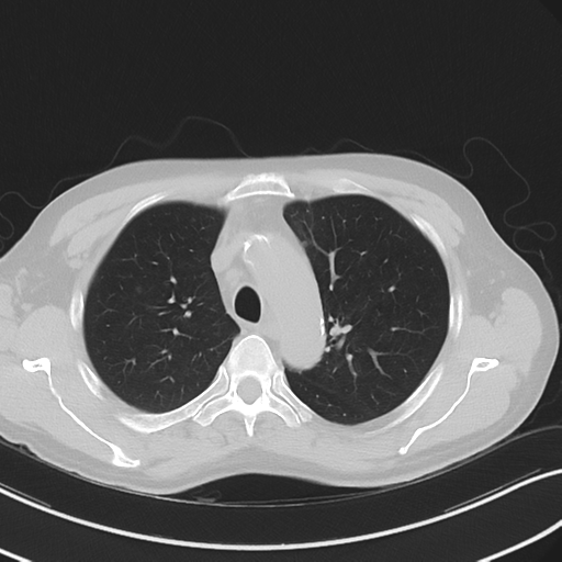 Apical pulmonary metastasis (Radiopaedia 46338-50754 Axial non-contrast 20).png
