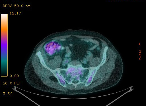 Appendiceal adenocarcinoma complicated by retroperitoneal abscess (Radiopaedia 58007-65041 Axial PET-CT 163).jpg