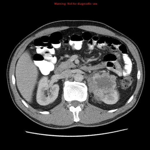 File:Appendicitis and renal cell carcinoma (Radiopaedia 17063-16760 A 20).jpg
