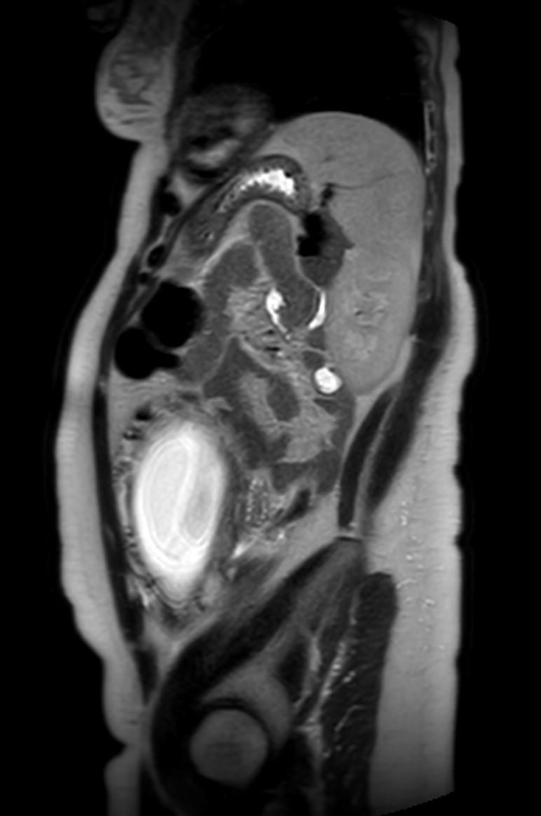 Appendicitis in gravida (MRI) (Radiopaedia 89433-106395 Sagittal T2 18).jpg