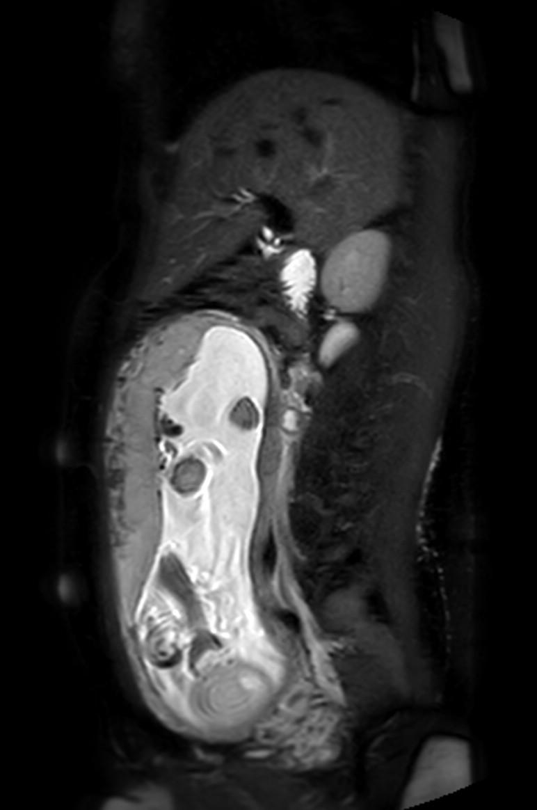 Appendicitis in gravida (MRI) (Radiopaedia 89433-106395 Sagittal T2 SPAIR 37).jpg