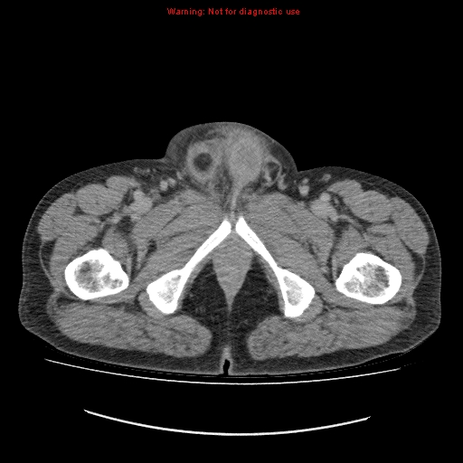 File:Appendicitis mass in inguinal hernia (Radiopaedia 26858-27029 A 37).jpg