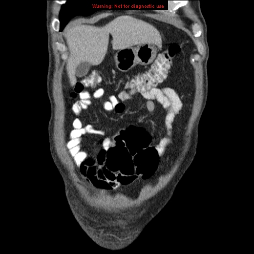 File:Appendicitis mass in inguinal hernia (Radiopaedia 26858-27029 B 9).jpg