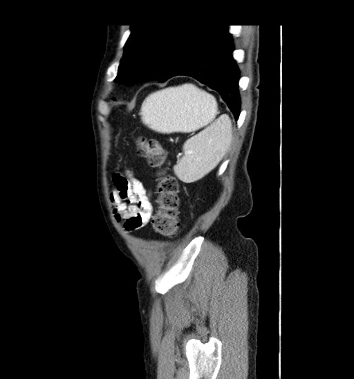 File:Appendicitis with localized perforation and abscess formation (Radiopaedia 49035-54130 C 56).jpg