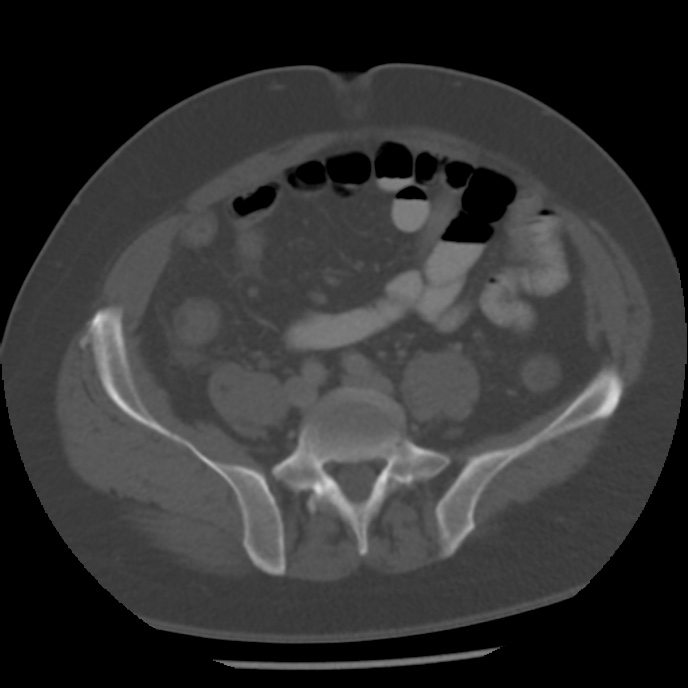 Appendicitis with perforation (Radiopaedia 35790-37342 Axial bone window 36).jpg