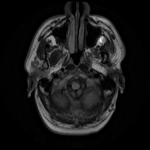 File:Aqueduct stenosis due to web (Radiopaedia 42207-45273 Axial FLAIR 2).png