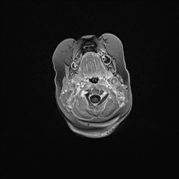 Aqueductal stenosis (Radiopaedia 73974-84802 Axial T1 C+ 23).jpg