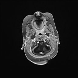 Aqueductal stenosis (Radiopaedia 73974-84802 Axial T1 C+ 36).jpg
