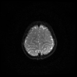 Arachnoid cyst - middle cranial fossa (Radiopaedia 86780-102938 Axial DWI 33).jpg