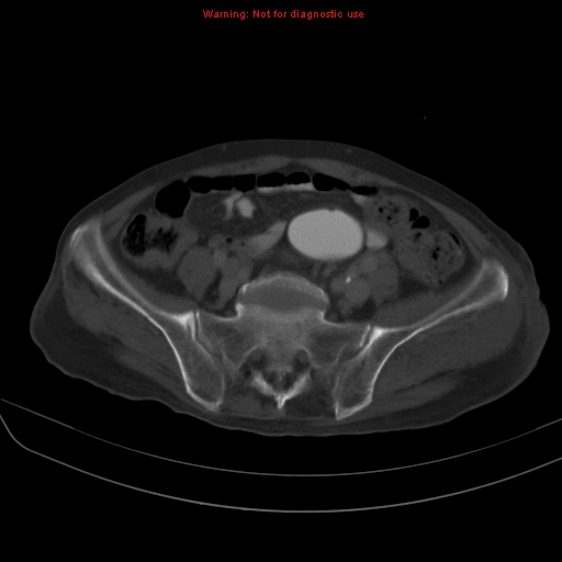 File:Arachnoiditis ossificans (Radiopaedia 51394-57136 Axial bone window 32).jpg