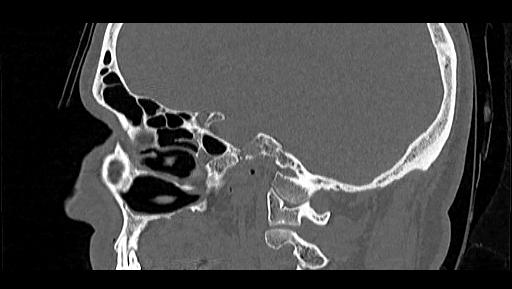 File:Arcuate foramen (Radiopaedia 89833-106944 Sagittal bone window 30).jpg