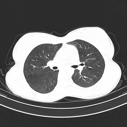 Arteria lusoria (Radiopaedia 88528-105192 Axial lung window 29).jpg