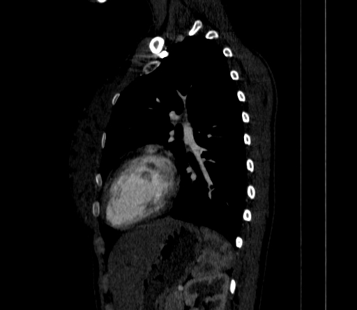 Arteria lusoria (Radiopaedia 88528-105192 C 64).jpg
