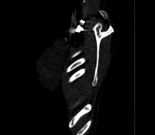 Arteria lusoria (Radiopaedia 88528-105192 C 84).jpg