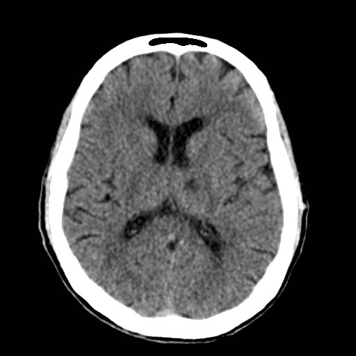 File:Artery of Percheron infarct (Radiopaedia 48088-52893 Axial non-contrast 25).jpg