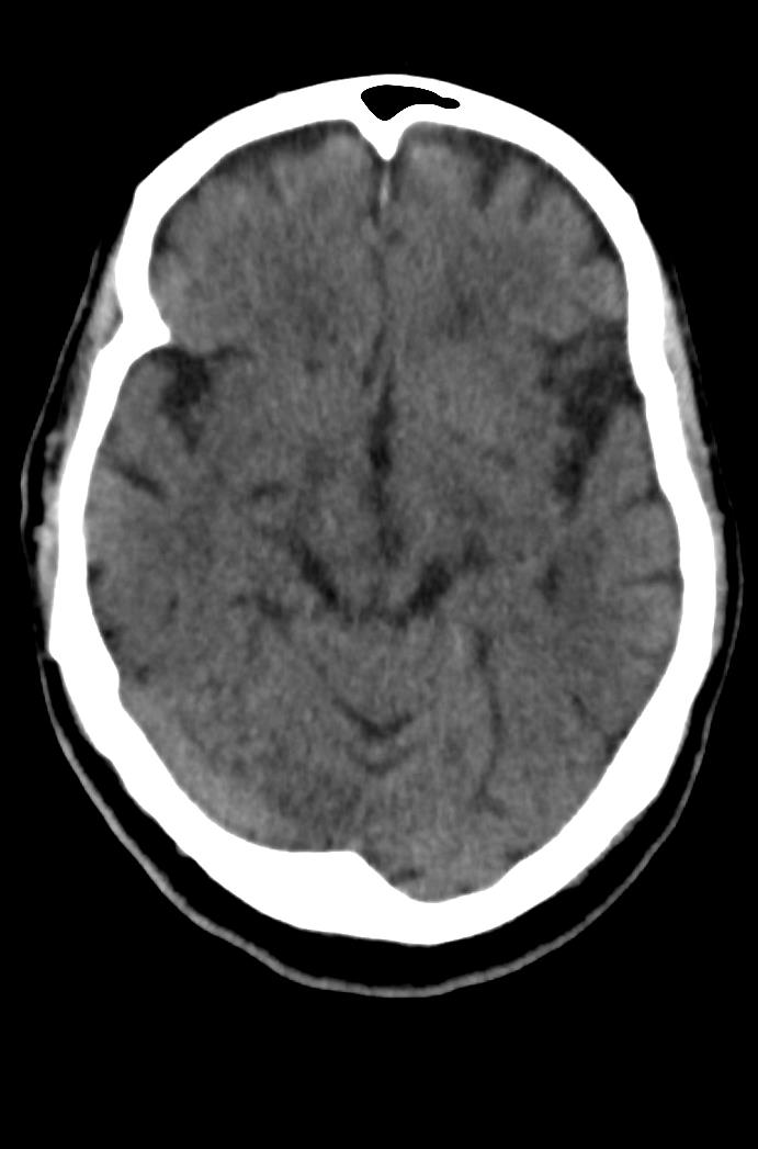 Artery of Percheron infarction (Radiopaedia 80613-94202 Axial non-contrast 81).jpg