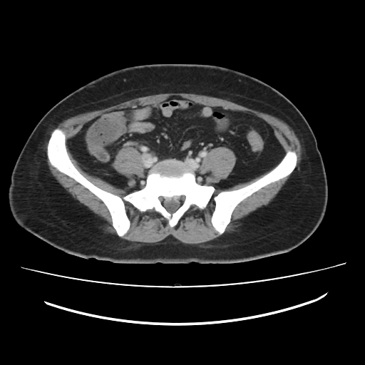 File:Ascending retrocecal appendicitis with liver abscesses (Radiopaedia 60066-67615 B 64).jpg