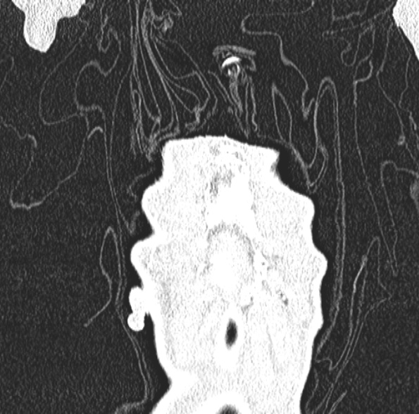 Aspergilloma- with Monod sign (Radiopaedia 44737-48532 Coronal lung window 109).jpg