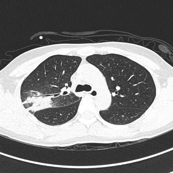 File:Aspergilloma (Radiopaedia 26223-26347 Axial lung window 27).jpg