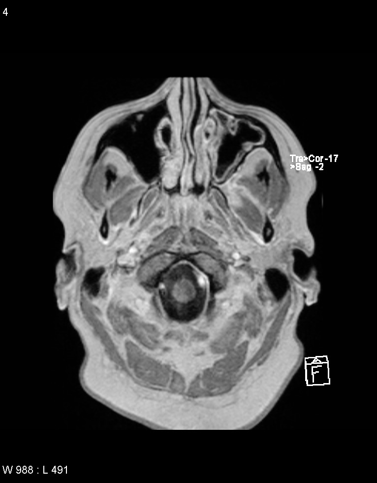 Astroblastoma (Radiopaedia 39792-42217 Axial T1 C+ 3).jpg