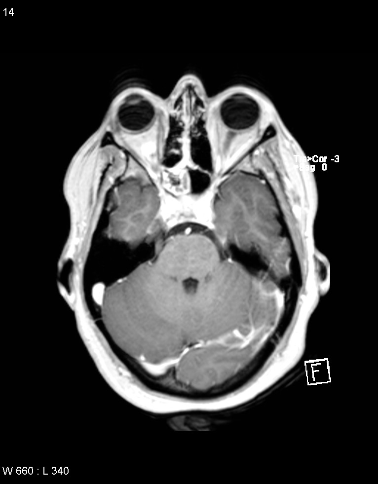 Astroblastoma (Radiopaedia 39792-42218 Axial T1 C+ 13).jpg