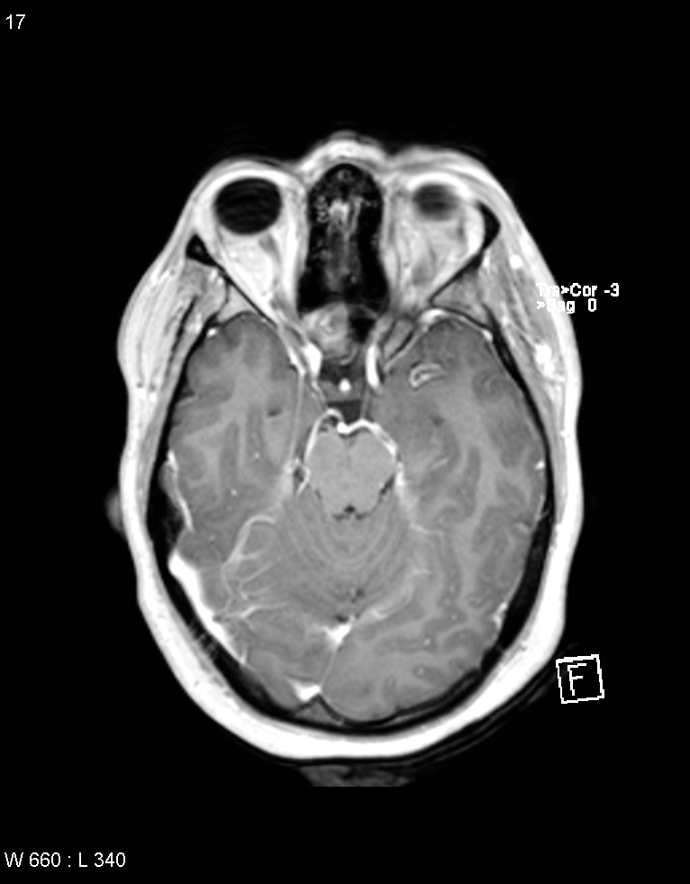 Astroblastoma (Radiopaedia 39792-42218 Axial T1 C+ 16).jpg