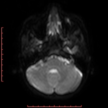 Astroblastoma (Radiopaedia 74287-85162 Axial DWI 16).jpg