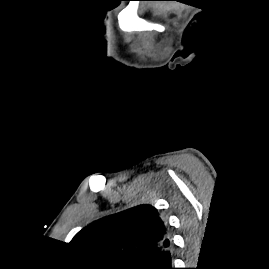 Atlanto-occipital dissociation (Traynelis type 1), C2 teardrop fracture, C6-7 facet joint dislocation (Radiopaedia 87655-104061 D 7).jpg
