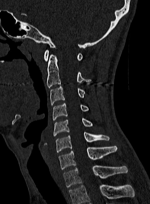 Atlantoaxial subluxation (Radiopaedia 44681-48450 Sagittal bone window 82).jpg