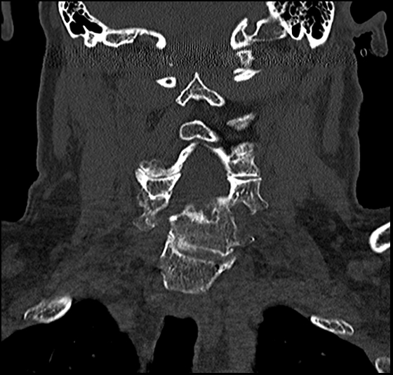 File:Atlas (type 3b subtype 1) and axis (Anderson and D'Alonzo type 3, Roy-Camille type 2) fractures (Radiopaedia 88043-104607 Coronal bone window 33).jpg