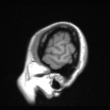 File:Atretic encephalocoele with inferior vermis hypoplasia (Radiopaedia 30443-31108 Sagittal T1 125).jpg
