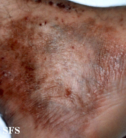 Atrophie Blanche (Dermatology Atlas 2).jpg