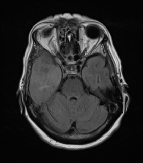 File:Atypical meningioma (WHO Grade II) (Radiopaedia 54742-60979 Axial FLAIR 9).png