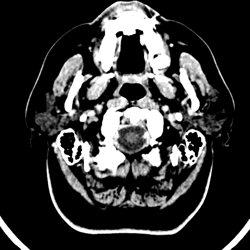 File:Atypical meningioma (WHO grade II) with brain invasion (Radiopaedia 57767-64728 Axial C+ 54).png