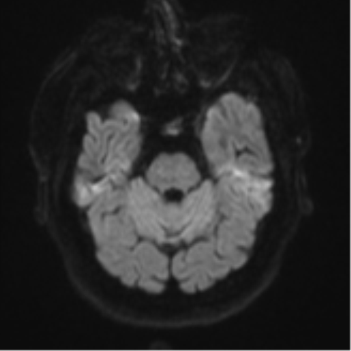 File:Atypical meningioma (WHO grade II) with brain invasion (Radiopaedia 57767-64729 Axial DWI 39).png