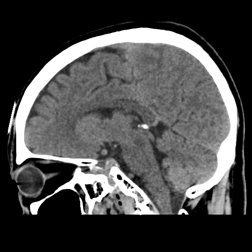 Atypical meningioma (WHO grade II) with osseous invasion (Radiopaedia 53654-59715 C 30).png
