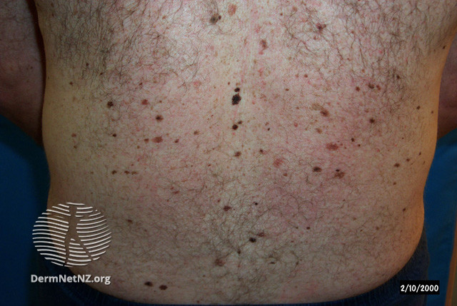File:Atypical naevi (DermNet NZ lesions-atypical-naevi-597).jpg